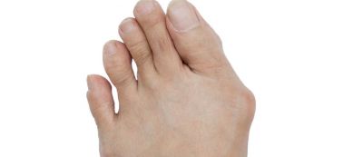 Hallux valgus, operasjon Hallux valgus, operasjon