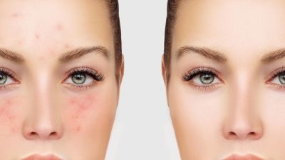 Rosacea Rosacea