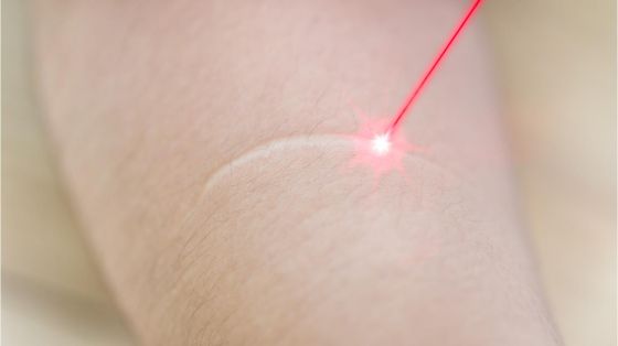 Arr behandling med laser
