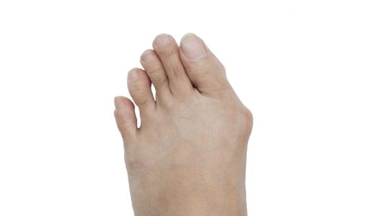 Hallux valgus