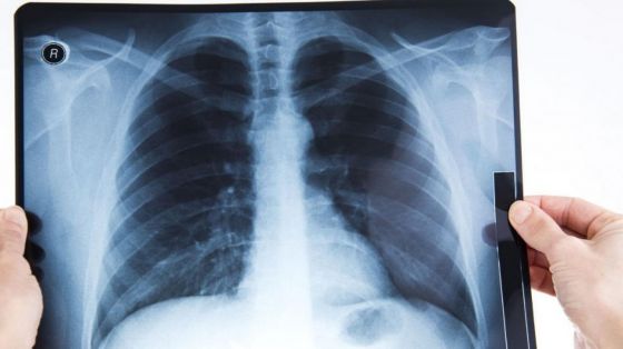 Røntgen thorax dykkerattest