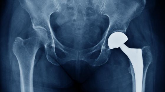 Hva er en hofteprotese?
