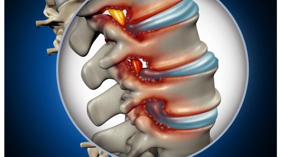 Hva er spinal stenose?