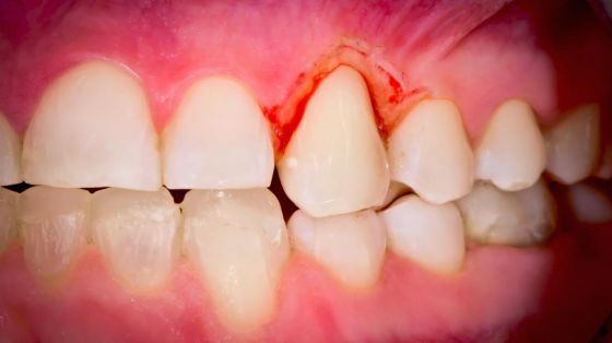 Kirurgisk inngrep ved behandling av marginal periodontitt