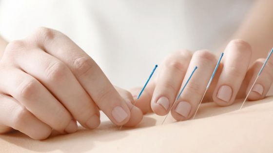 Medisinsk akupunktur