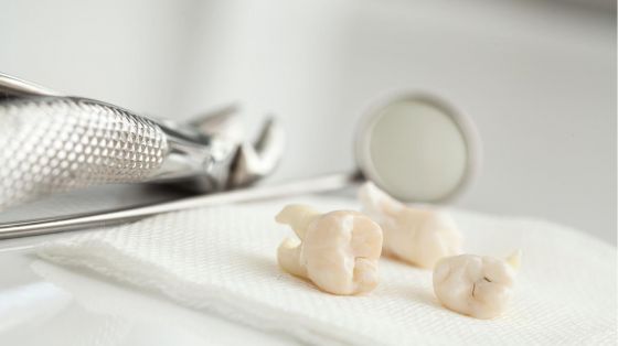 Ukomplisert ekstraksjon av tann eller rot