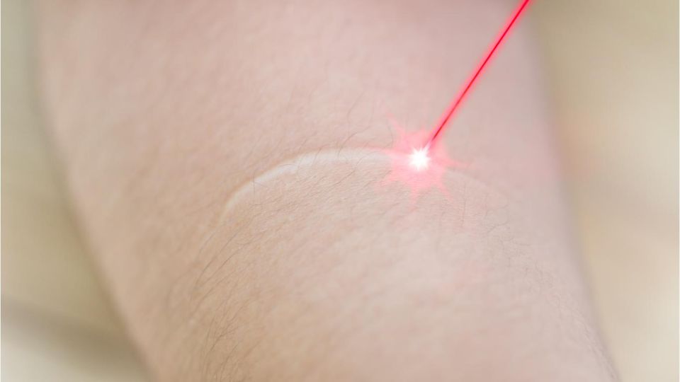 Arr behandling med laser